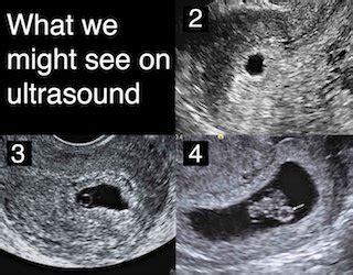 understanding early ultrasound timings